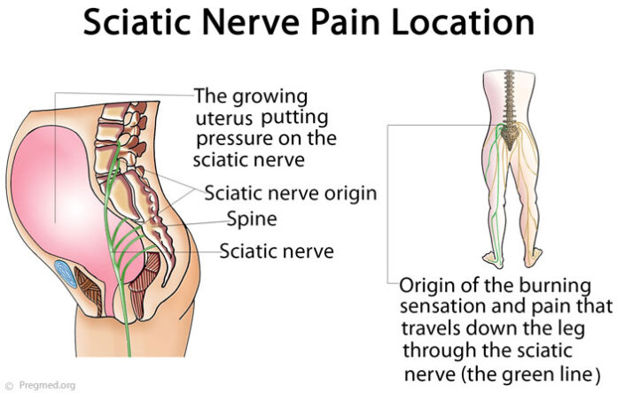 Sciatica Pain During Pregnancy Relief | safe4cure